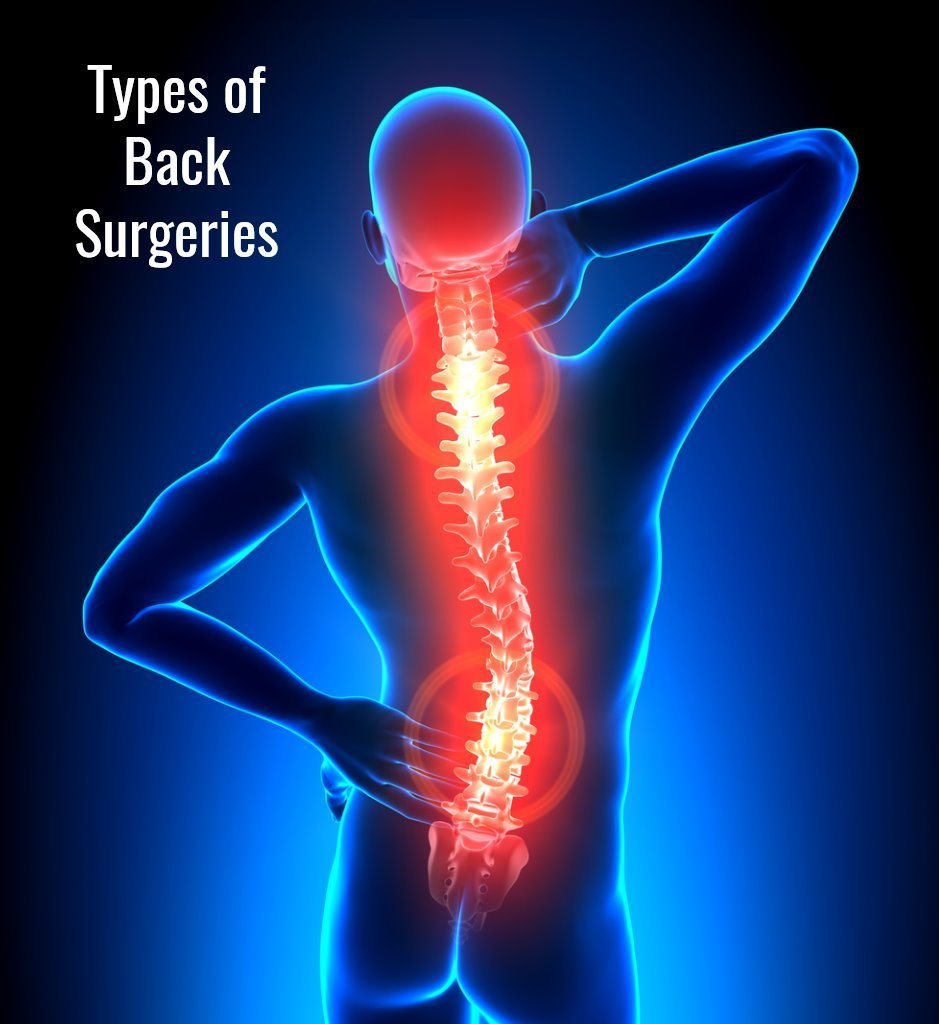 Types of Back Surgeries JOI