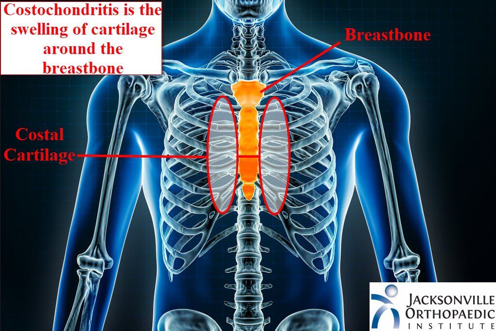 Costochondritis Cks
