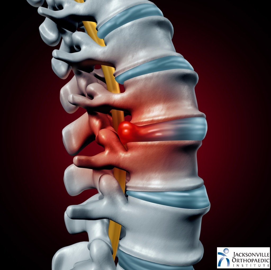 Herniated Disc